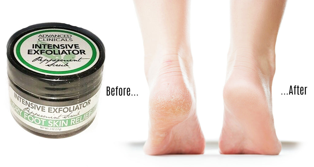 Advanced Clinicals Intensive Dry Foot Exfoliator Peppermint Scrub- 1 fl. ozAdvanced Clinicals Intensive Dry Foot Exfoliator Peppermint Scrub- 1 fl. oz
