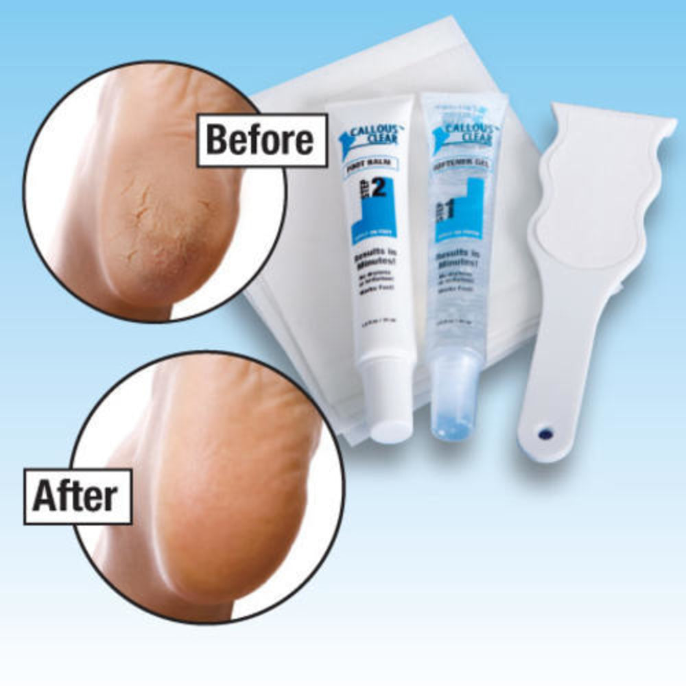 foot callus treatment