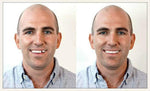 Instant Smile Select A Tooth Temporary Tooth Replacement Kit- Combo