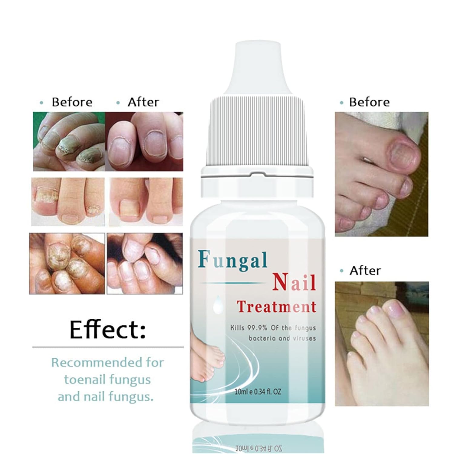 5pcs Nail Fungal Removal Ointment Toenail Whitening Nail Repair Treatment  Cream Anti Infection Paronychia Onychomycosis A655 | Fruugo KR