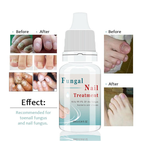 Nail Fungal Treatment Antifungal 30ml Nail Liquid Fingernail Care Effective  | eBay