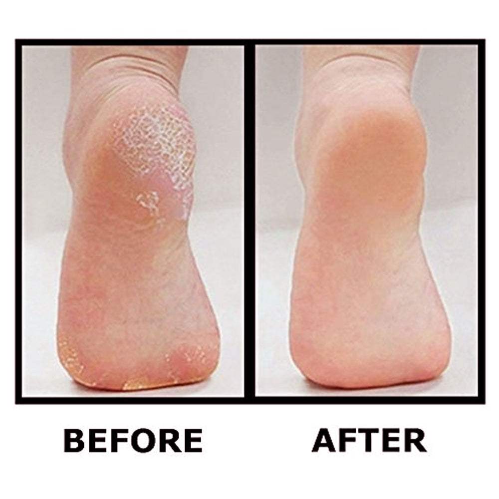 Best Pedicure Foot File - Professional Foot Callus Scrubber