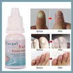 toenail fungus treatment