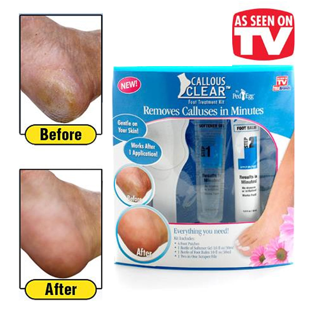 Callous Clear Foot Treatment Kit - Removes Calluses in Minutes