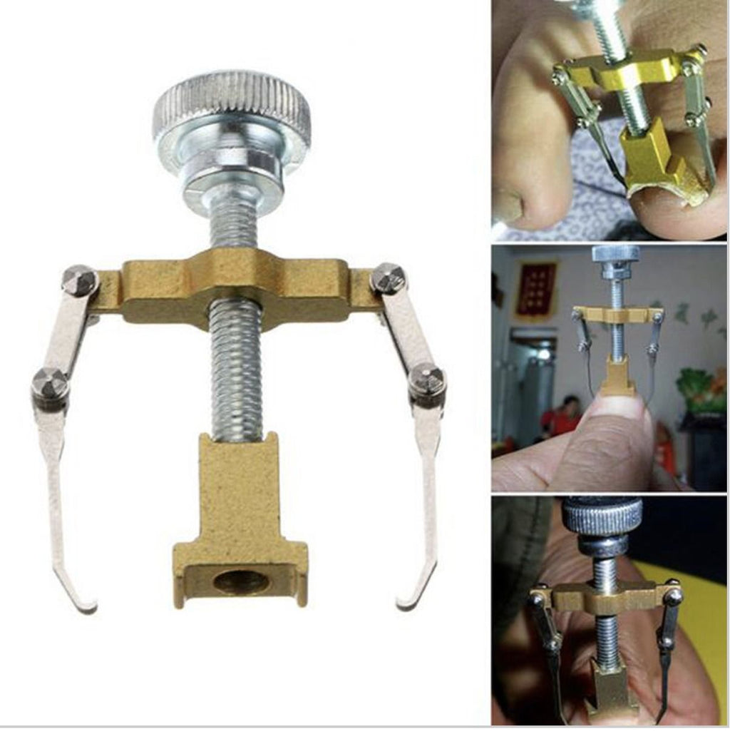 ingrown toenail corrector