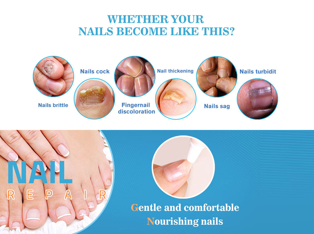 fungal nail treatment
